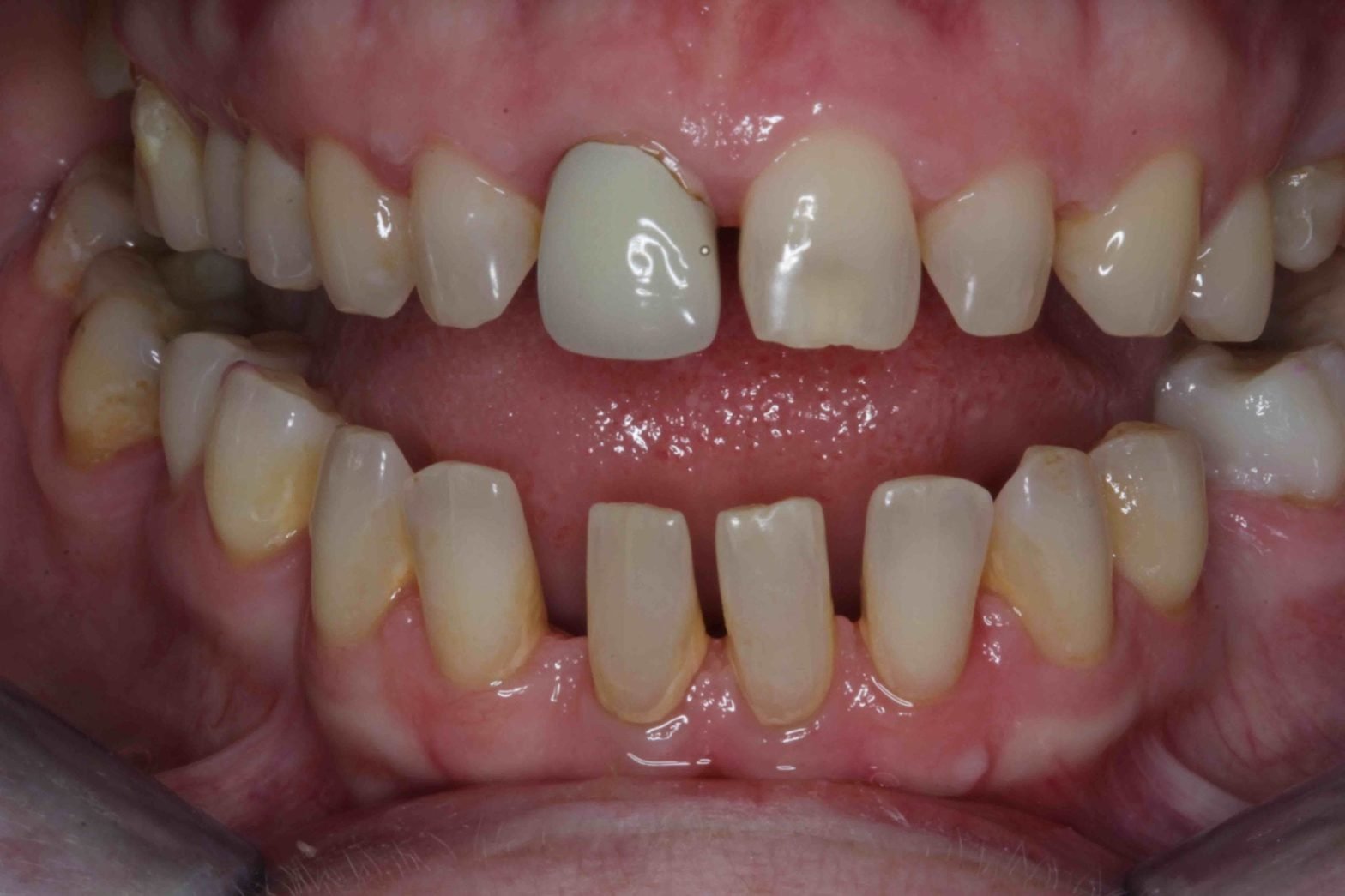 porcelain veneers before and after