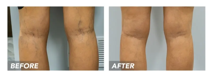 varicose vein doctor NYC