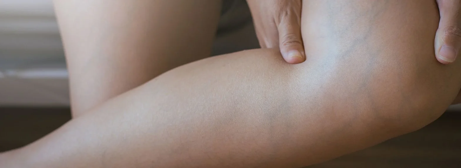 varicose vein treatment New York